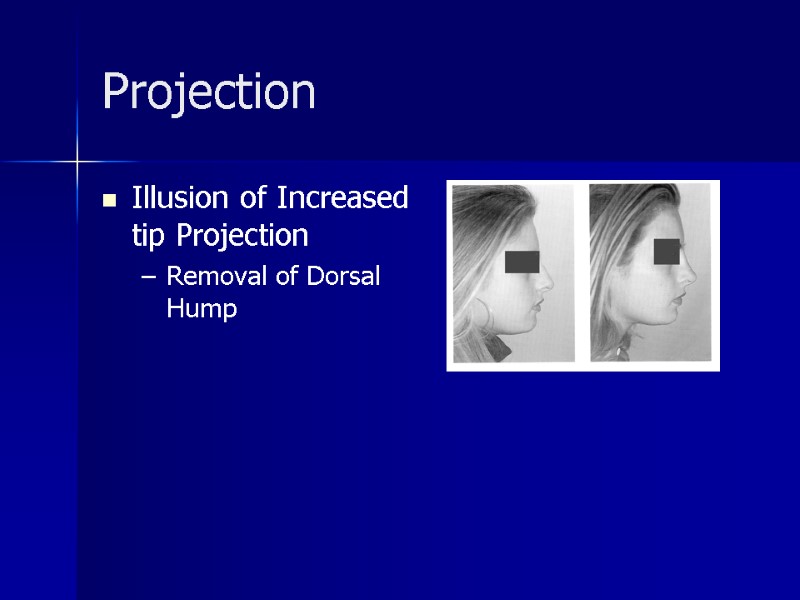 >Projection Illusion of Increased tip Projection Removal of Dorsal Hump